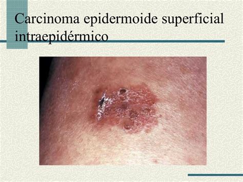 carcinoma epidermóide